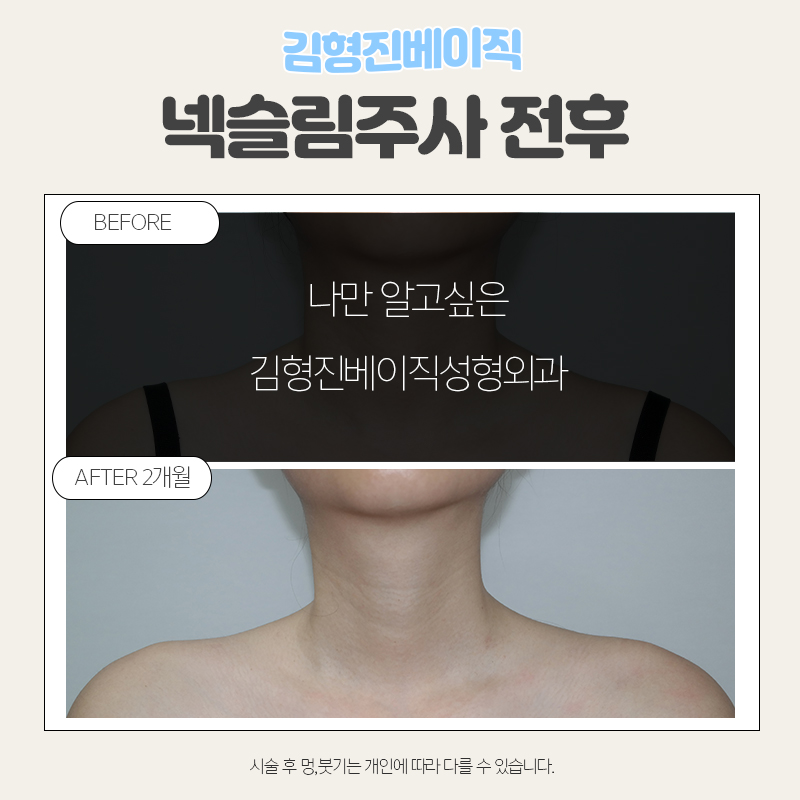 넥슬림주사시술이 궁금하시다면 관련 이미지 4