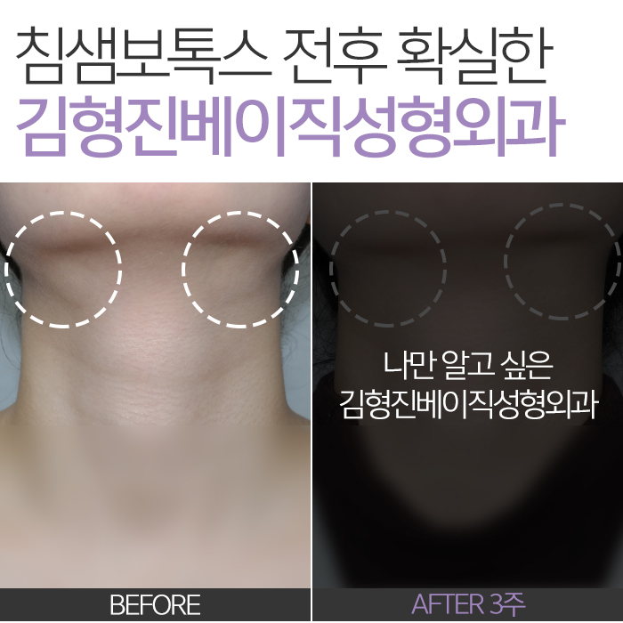침샘보톡스전후 차이, 보이세요? 관련 이미지 2