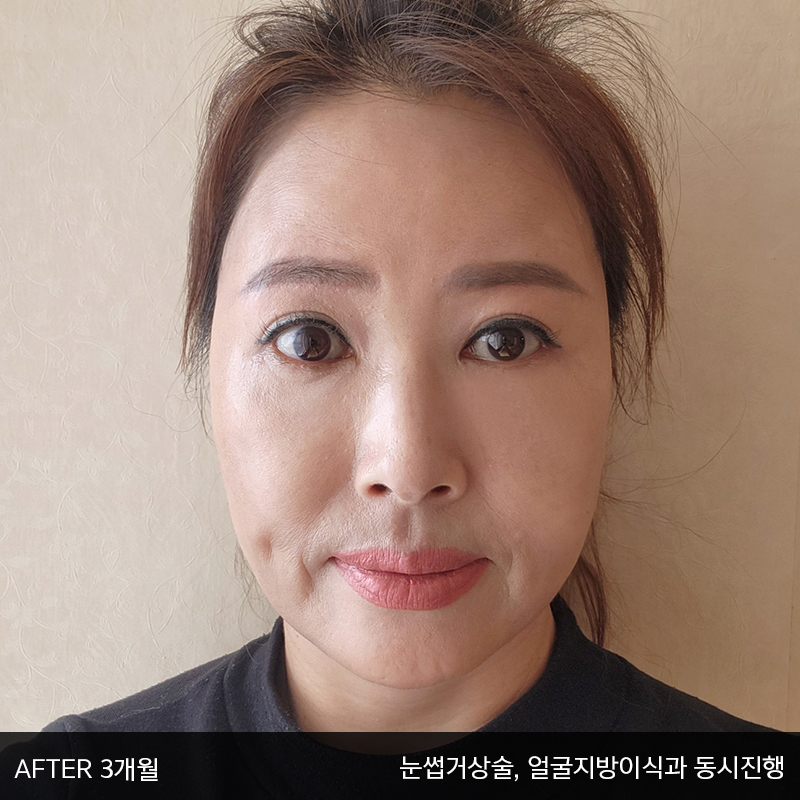 중년눈밑지방수술 아직 모르신다면 관련 이미지 8