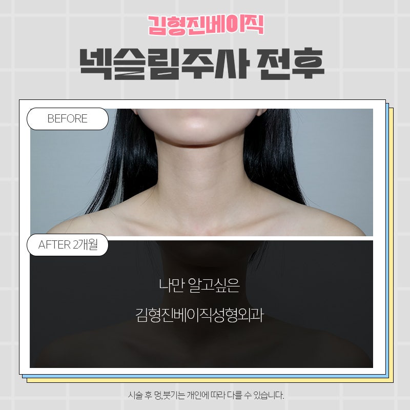넥슬림보톡스전후 궁금하신분!? 관련 이미지 7