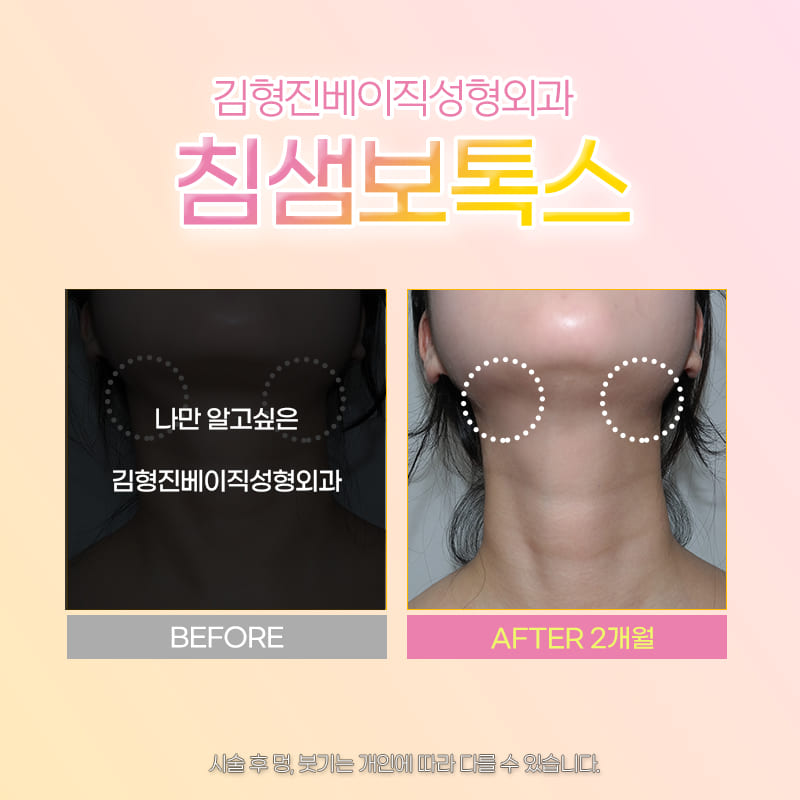 침샘보톡스추천 하면 김형진베이직 관련 이미지 6