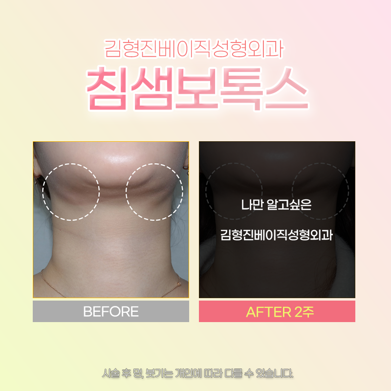 침샘보톡스주기 확인하고 시술 받아야 하는 이유 관련 이미지 5