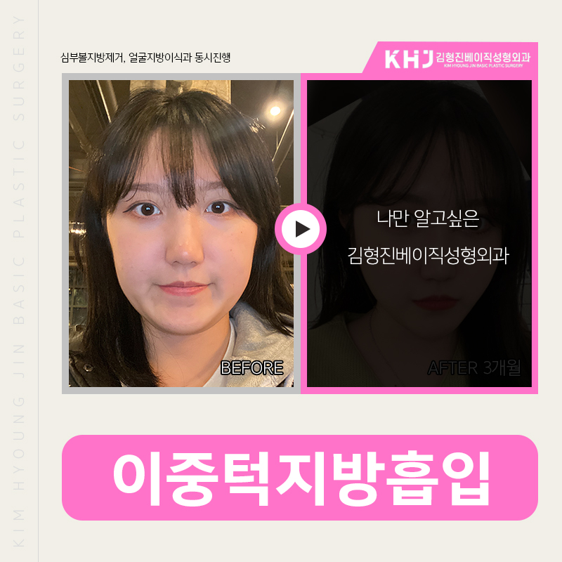 이중턱지방흡입전후 차이가 큰 김형진베이직 관련 이미지 2