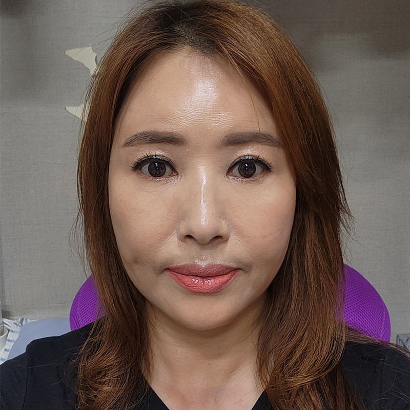 중년눈밑수술 김형진베이직에서 하셔야죠! 관련 이미지 1