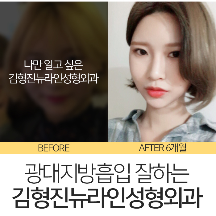 광대지방흡입 김형진뉴라인성형외과지 관련 이미지 2