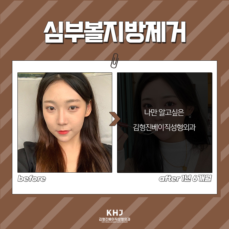 압구정심부볼제거 심술보 같은 불독살이 고민이라면? 관련 이미지 6