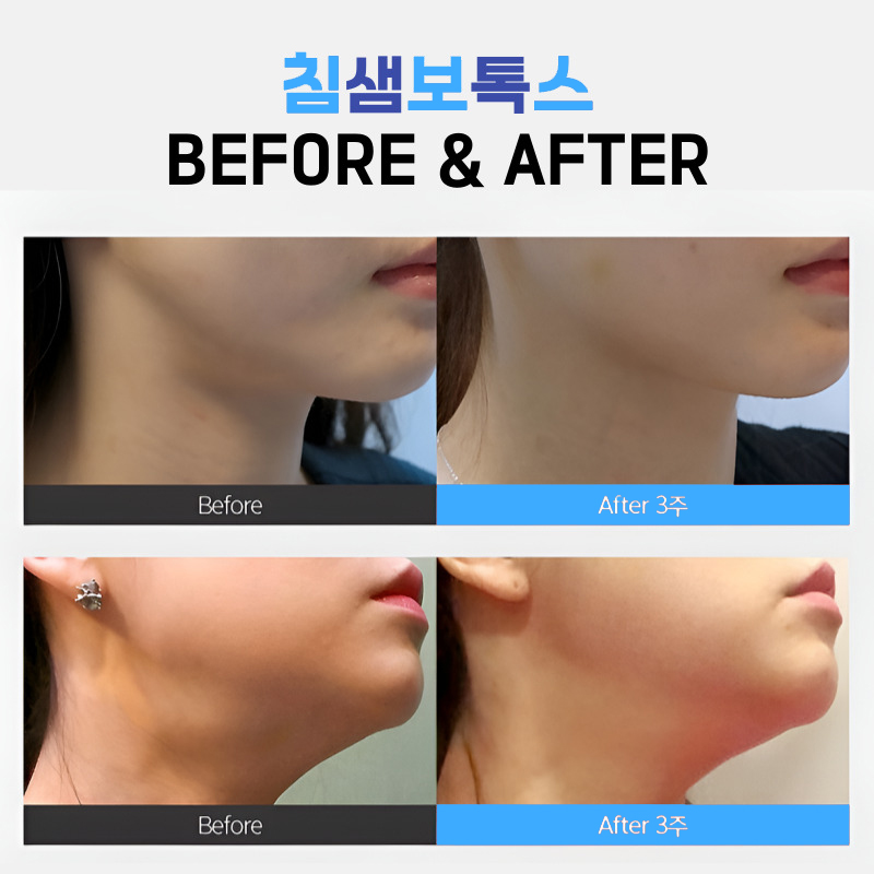 점점 커지는 침샘치료 너무 만족스러워요 관련 이미지 6