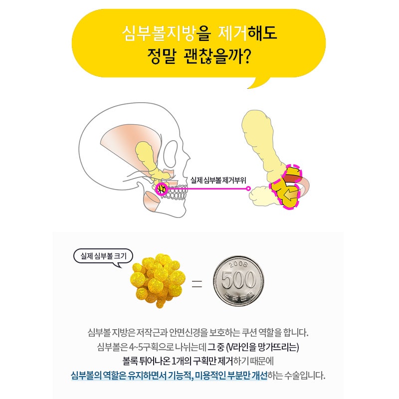 역대급 심부볼지방제거후기! 잃어버린 V라인 되찾았어요 관련 이미지 4