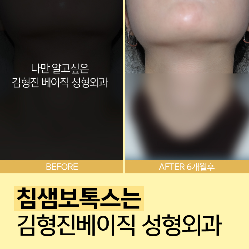 침샘보톡스로 숨어있던 턱선 발견 관련 이미지 2