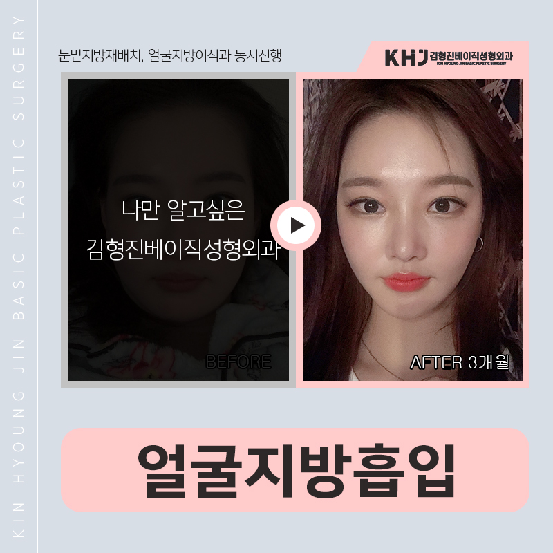 얼굴지방흡입후기 바로 여기에요! 관련 이미지 4