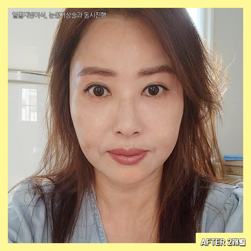 중년눈밑성형 아직도 고민하신다면 관련 이미지 5