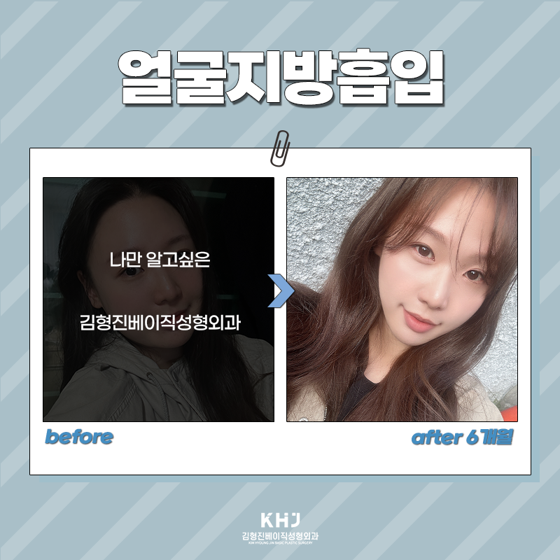 얼굴지방흡입잘하는곳 찾고 계셨다면? 관련 이미지 4