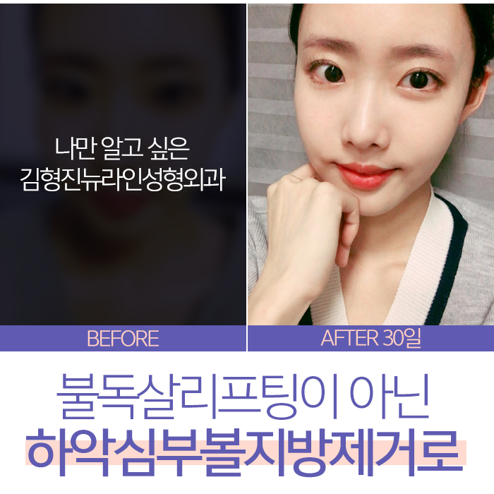 불독살 리프팅으론 안된다구요 관련 이미지 7