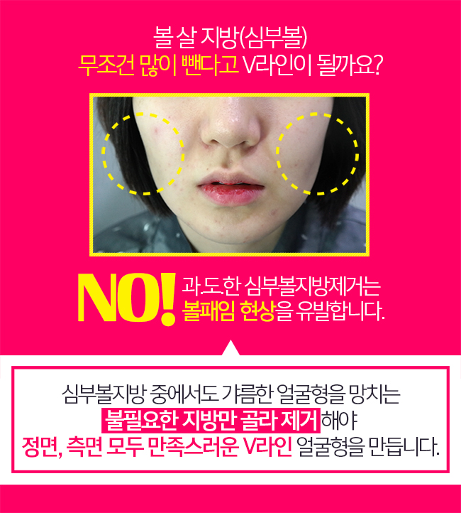 심부볼지방제거성형외과 김형진뉴라인을 몰라요? 관련 이미지 3