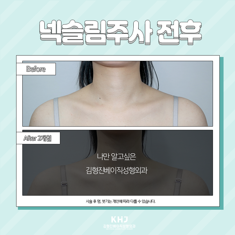 넥슬림주사효과 아직도 모르신다구요? 관련 이미지 4