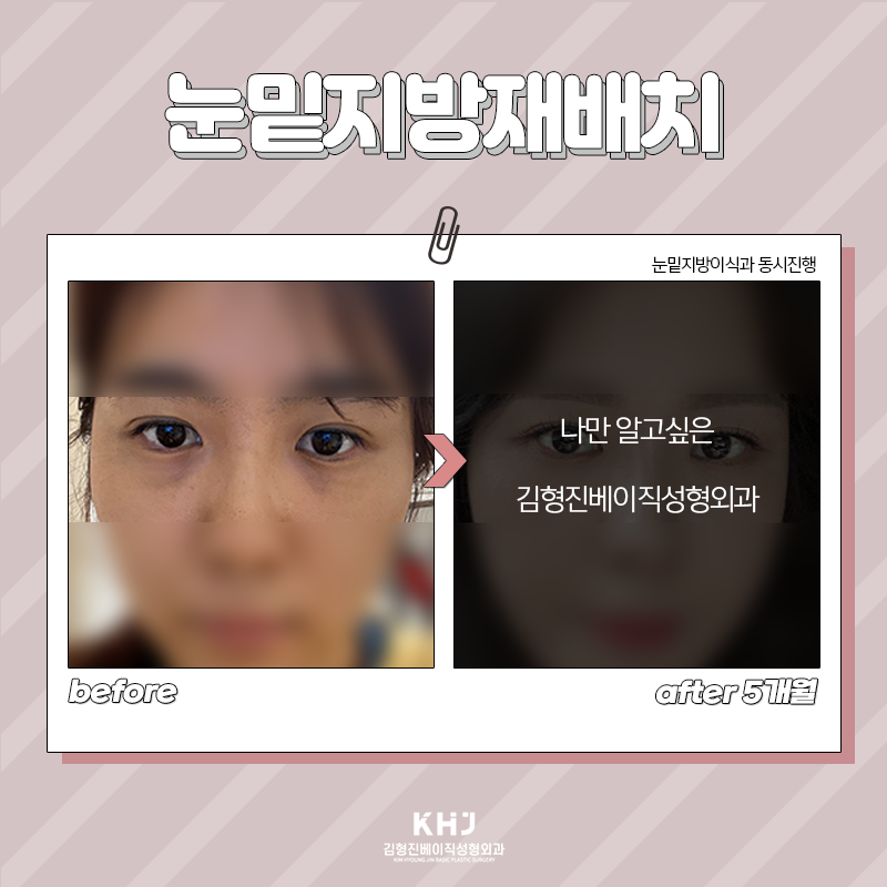 눈밑지방재배치재발 걱정하지 마세요! 관련 이미지 5