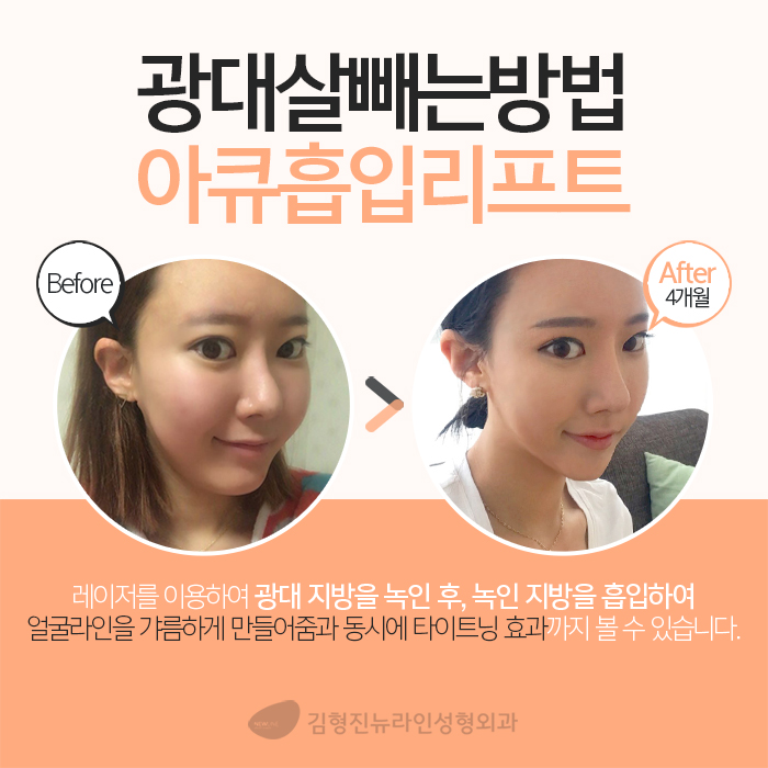 광대살빼기 어려운 게 아니네 관련 이미지 3