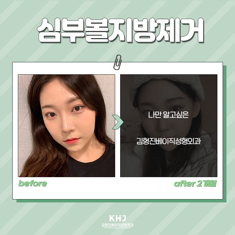 심부볼제거전후 후기 좋은 곳 찾으셨나요? 관련 이미지 4