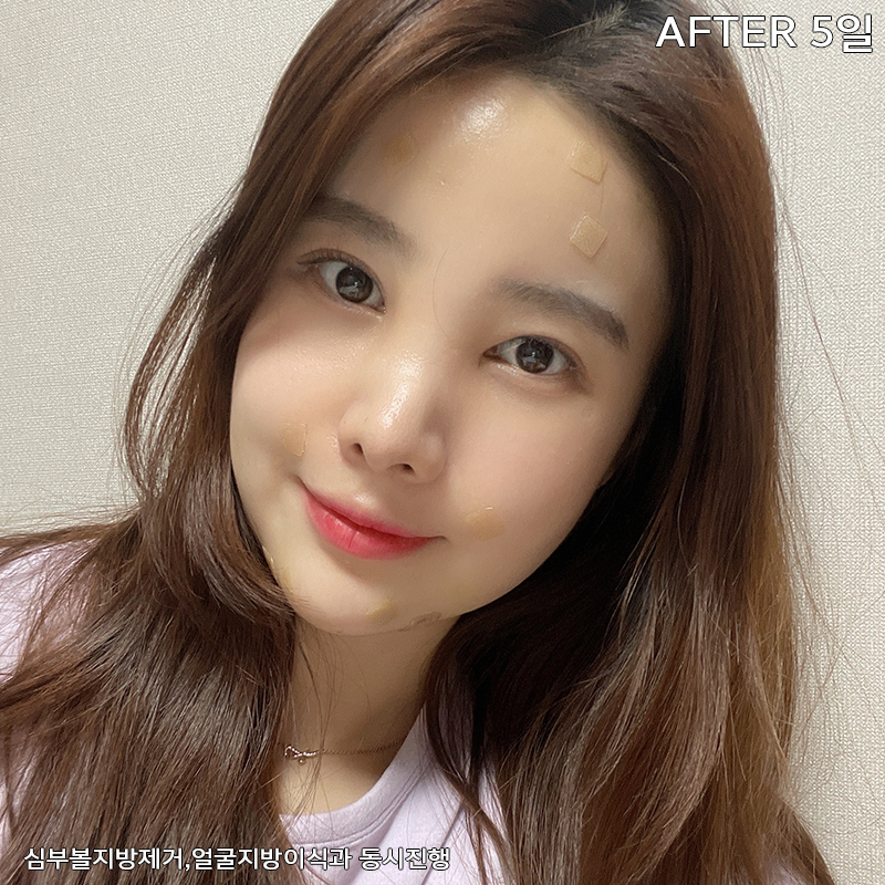 얼굴살제거 방법? 바로 알려드릴게요! 관련 이미지 4