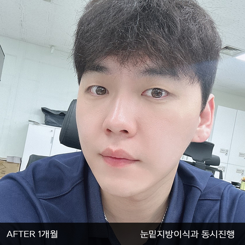 눈밑지방재배치수술이 궁금하시다면 관련 이미지 6