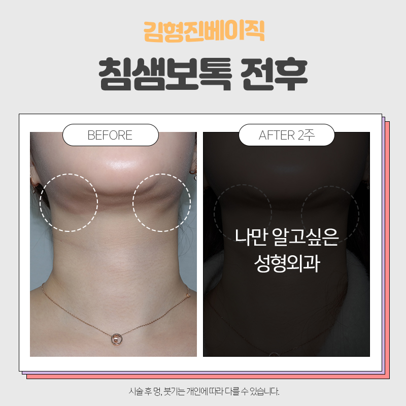 턱밑침샘보톡스효과 모르면 안돼죠 관련 이미지 5