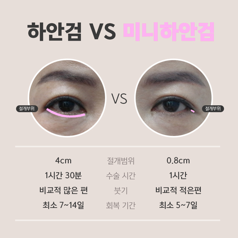 눈밑처짐수술전후 눈밑 흉터 걱정 없었어요 관련 이미지 4