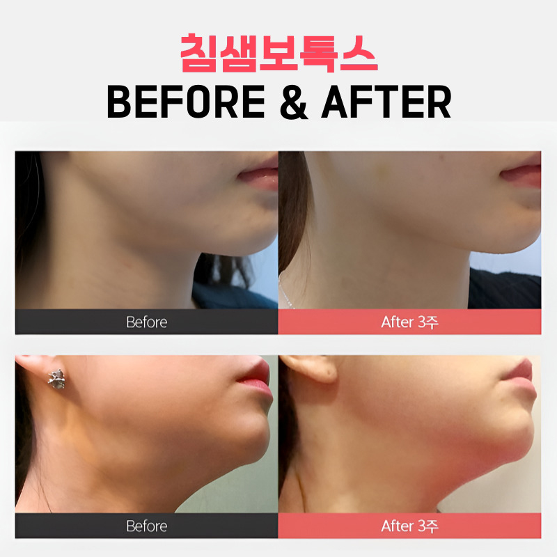 턱 라인 만들고 침샘치료까지 동시에 하려면 관련 이미지 5