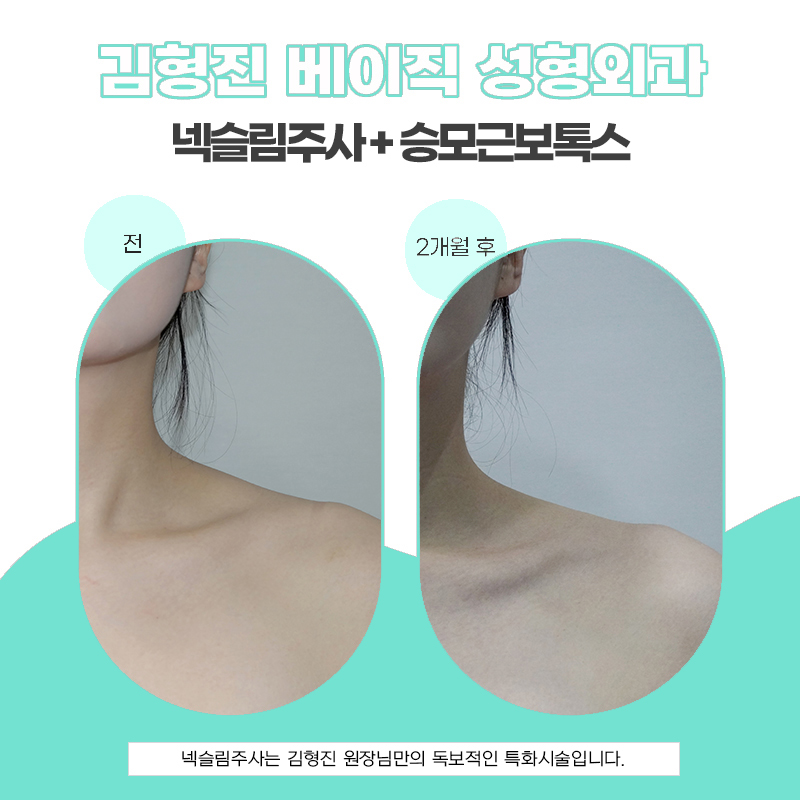 아직도 웨딩관리로 이걸 안한다고요? 관련 이미지 6