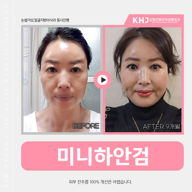 미니하안검전후 변화과정 확인하세요! 관련 이미지 4