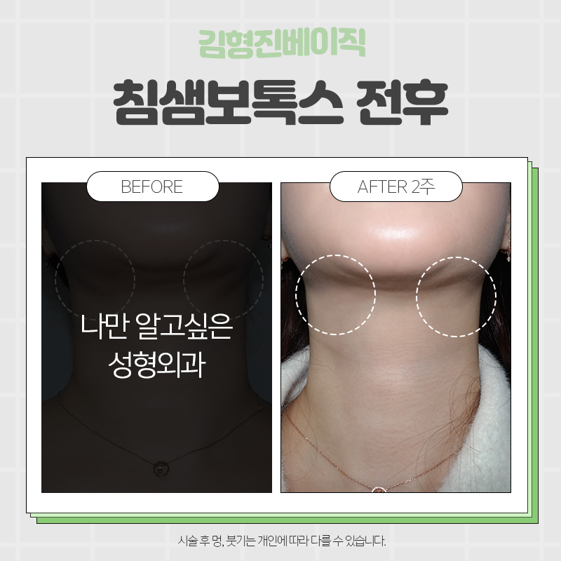 침샘보톡스전후 갸름한 턱선 간편하게 완성! 관련 이미지 7