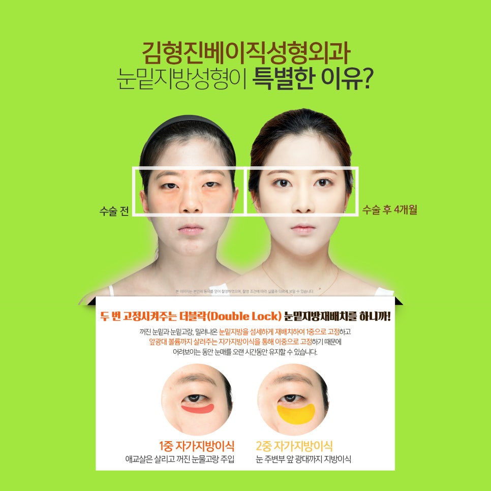 눈밑지방수술 했더니 인상까지 좋아졌어요! 관련 이미지 5