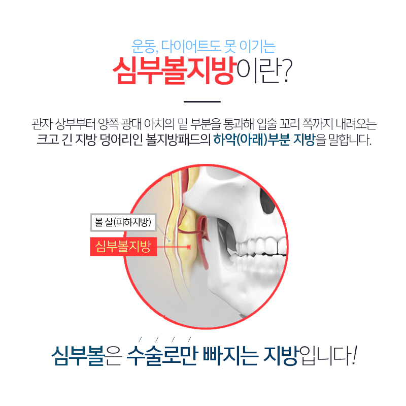 압구정얼굴지방흡입 덕분에 보름달 얼굴 극복했습니다! 관련 이미지 4