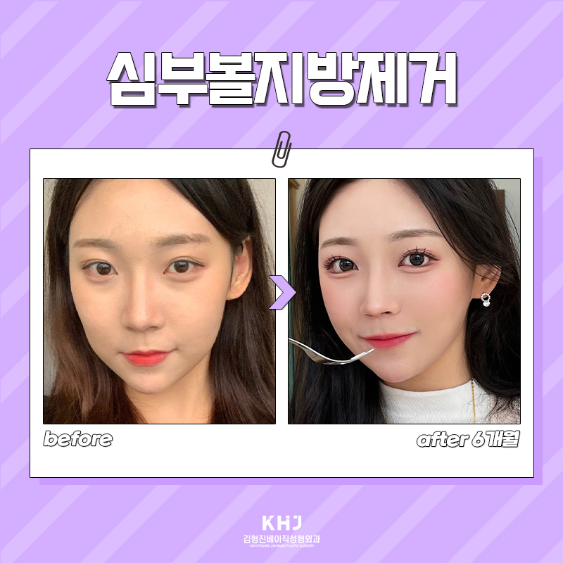 당신만 몰랐던 진짜 볼살없애는법 관련 이미지 5