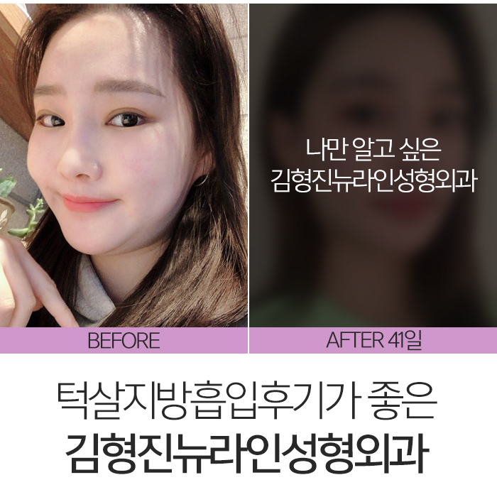 턱살지방흡입후기 확실한 곳 찾아요? 관련 이미지 3