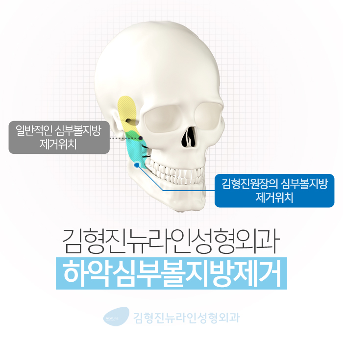 남자심부볼제거 해도 될까? 관련 이미지 4
