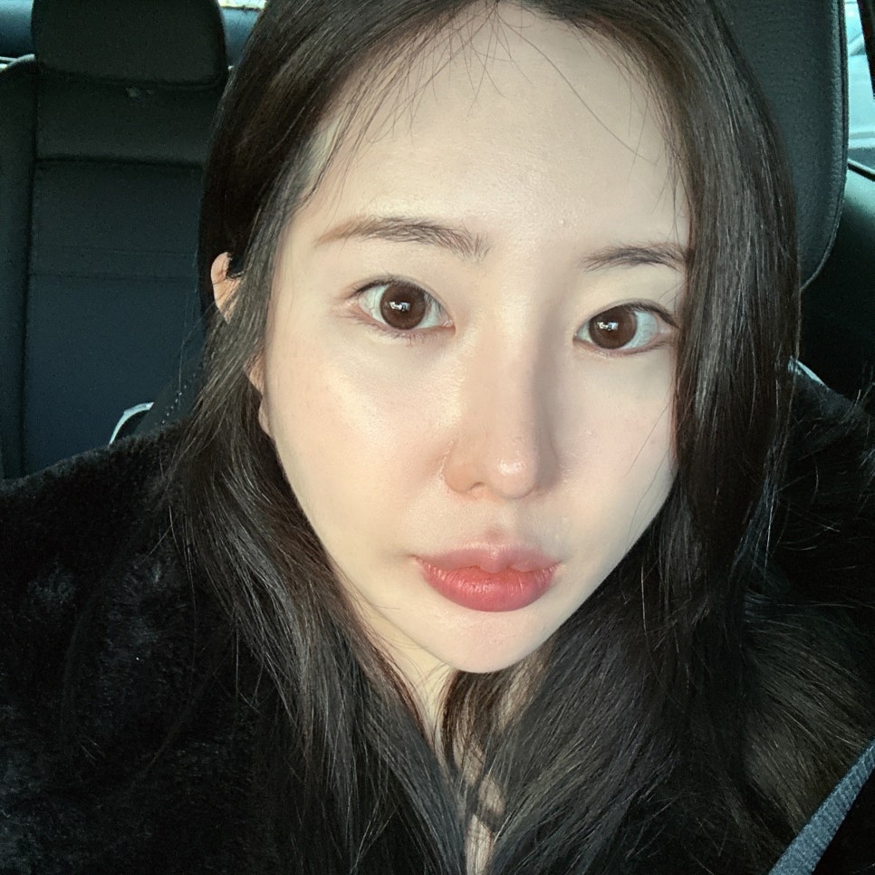 Cheek Fat Removal at a Place That Specializes in It image 3