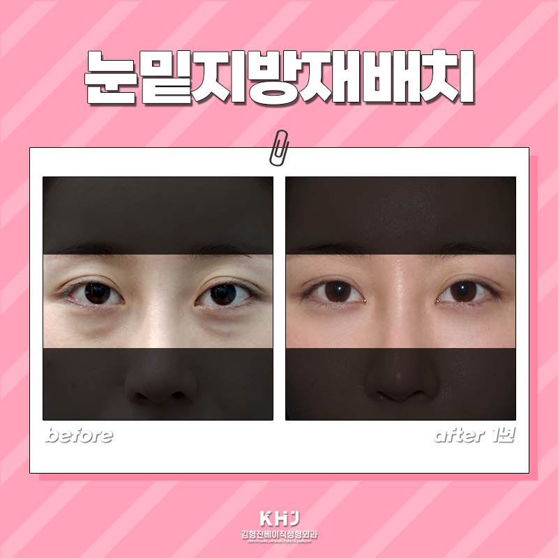 압구정눈밑수술 아직도 마음에 드는 곳이 없다면 관련 이미지 6