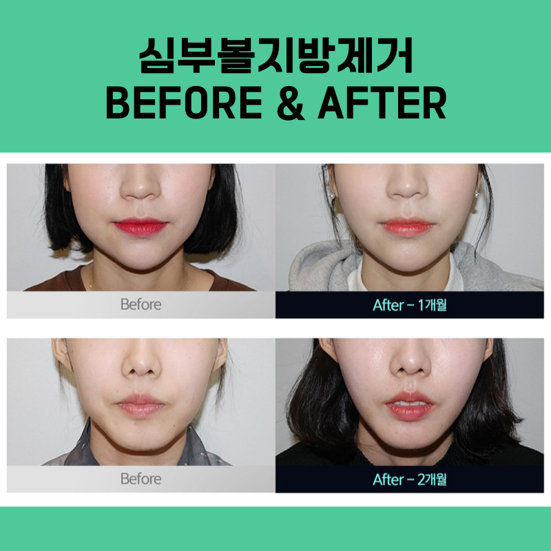 턱선이 예뻐지는 압구정심부볼지방제거 찾고 있다면? 관련 이미지 5
