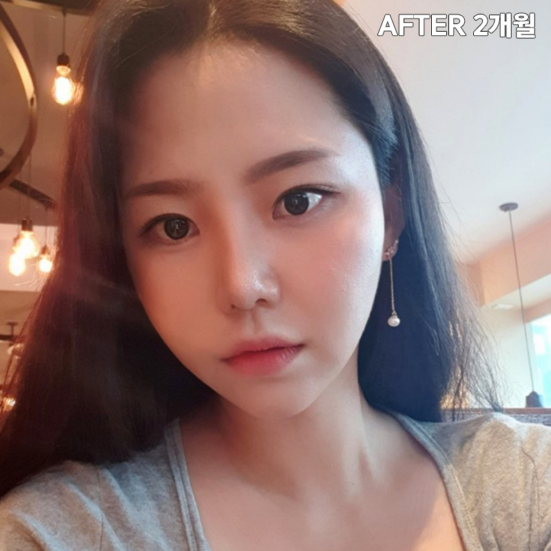 얼굴살빼는법! 전후 차이 확실하게 관련 이미지 5