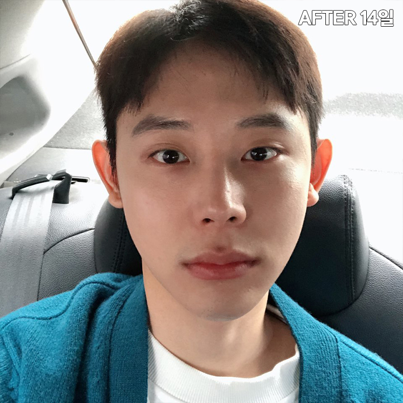 남자심부볼제거? 당연히 가능하죠! 관련 이미지 5