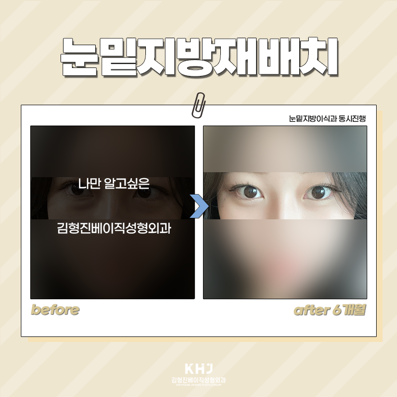 눈밑지방재배치재발 걱정 없는 이유 관련 이미지 5