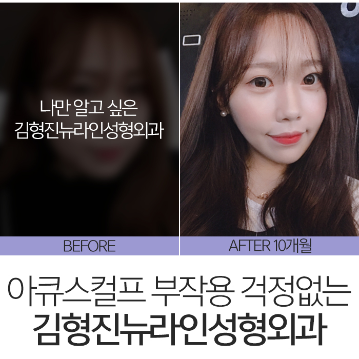아큐스컬프부작용 걱정된다면 관련 이미지 2