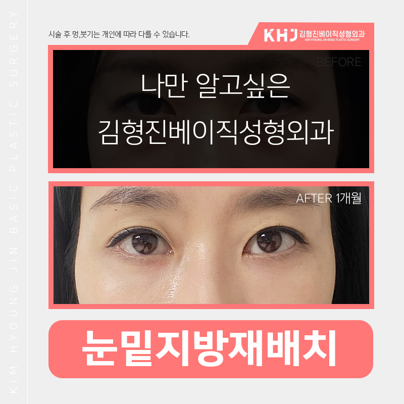 눈밑지방재배치흉터 보이지 않는 게 맞아요! 관련 이미지 4