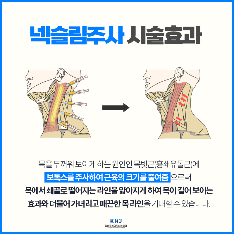 목보톡스로 두꺼운 목 라인을 슬림하게 가꾸는 방법 관련 이미지 4