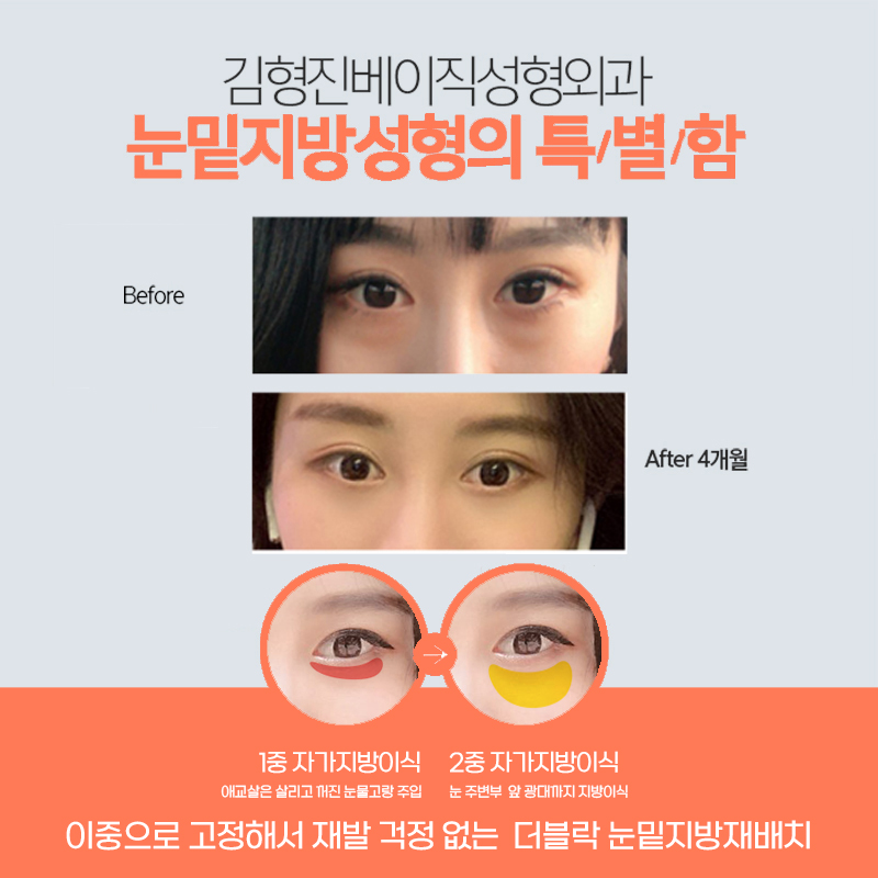 눈밑지방재배치후기 미묘한 차이가 인상을 바꿔요 관련 이미지 3