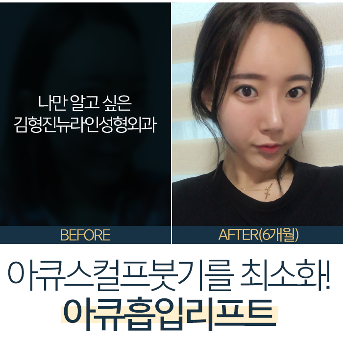 아큐스컬프붓기 급이 다른 이유 관련 이미지 5