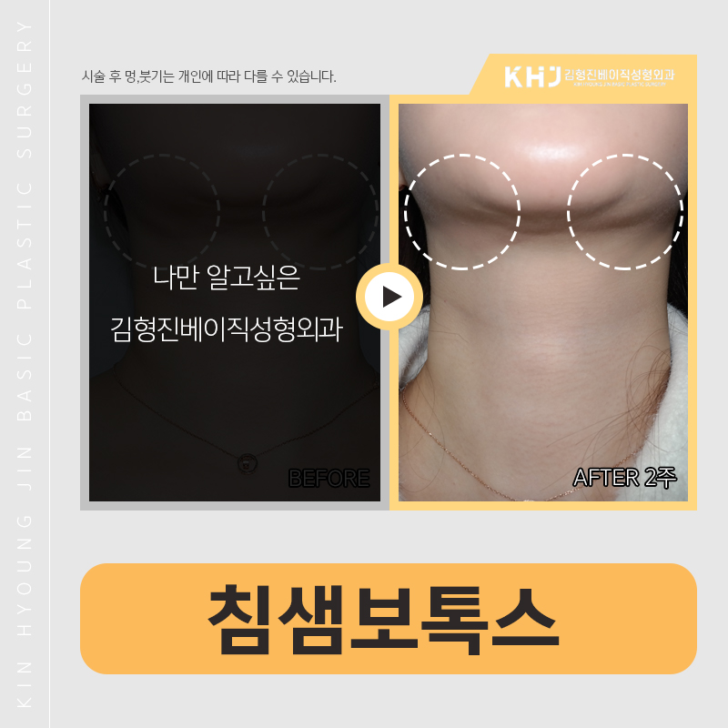 침샘보톡스위치 궁금하시다구요? 관련 이미지 4