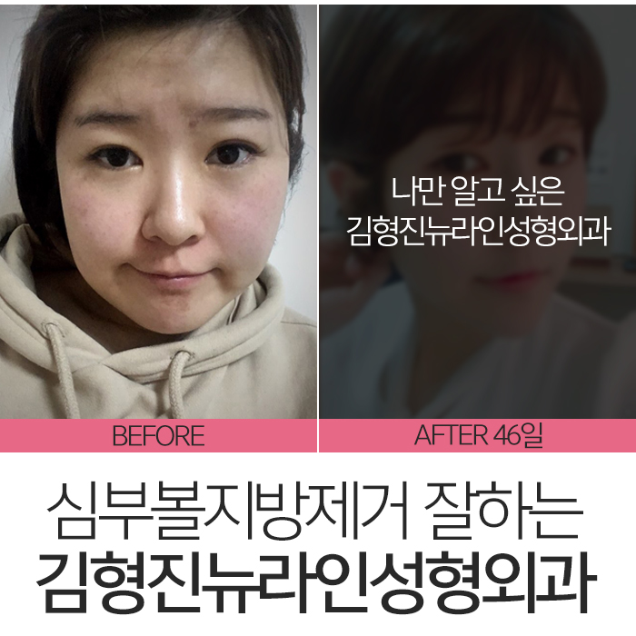 압구정심부볼제거 남다른 후기 관련 이미지 2