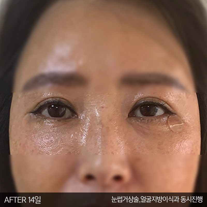 중년눈밑수술 잘하는 김형진베이직 관련 이미지 4