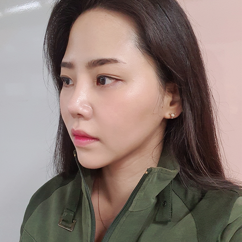 침샘보톡스시술주기 확인하셔야죠! 관련 이미지 2